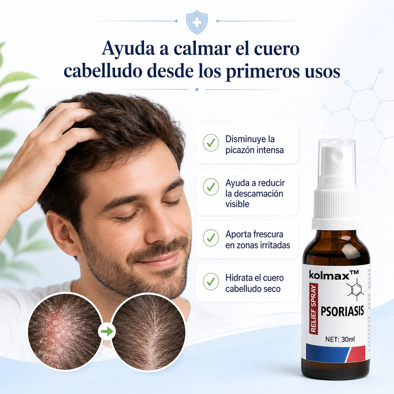 Spray para la psoriasis capilar (30ML) - Desaparece la caspa inflamatoria en el cuero cabelludo desde los 7 días de uso