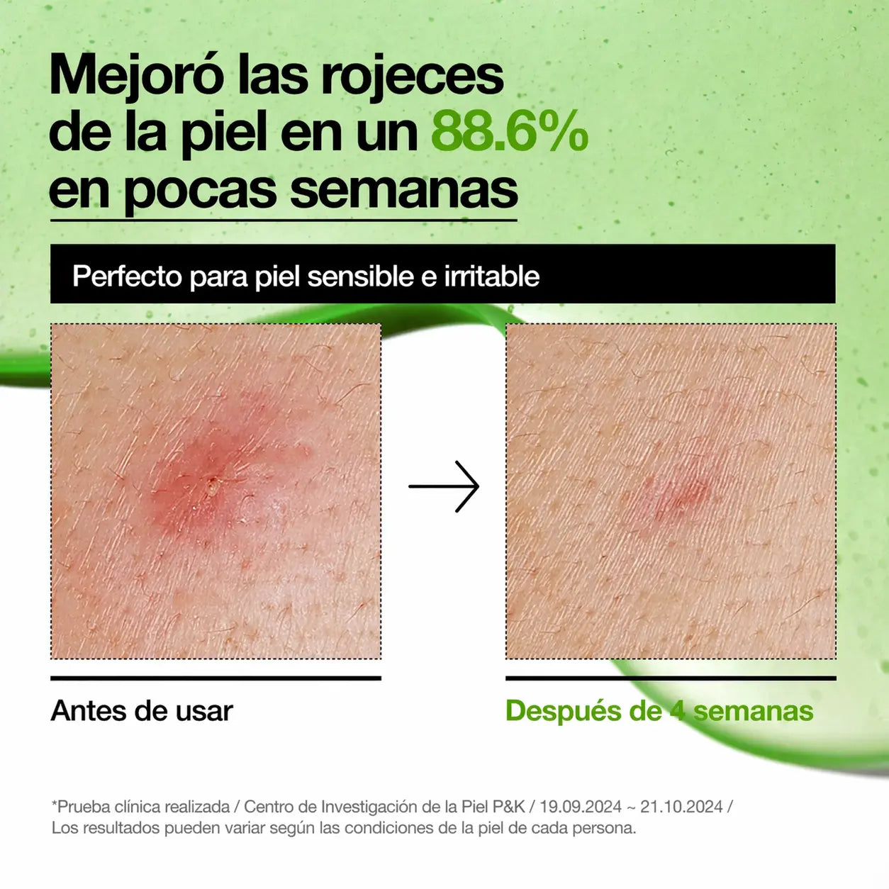 Anua® Ácido Azelaico 10% de 30ml - Disminuye las rojeces en tu piel causadas por irritación y post-acné
